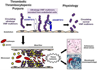 Molecular Diagnosis Is Vital to the Accurate Classification and Management of Thrombotic Thrombocytopenic Purpura in Children